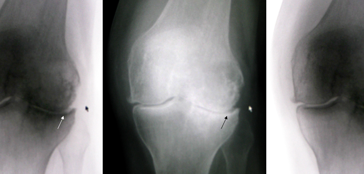 Causes of Accelerated Knee OA; Lumbar Prolapse Caused Deficits; Sealants Over Sutures?