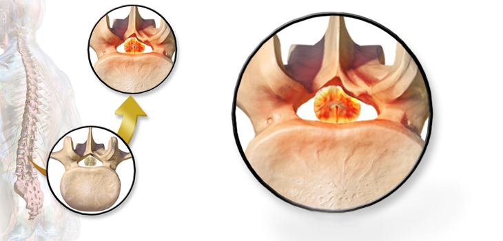 The Genetic Origins of Spinal Stenosis; Robust Steroid Study for Knee OA; New Tool Improves Surgical Training