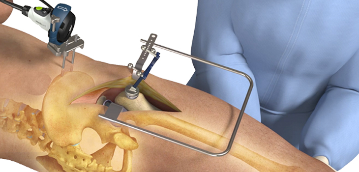Intellijoint Surgical: CE Mark for Hip System