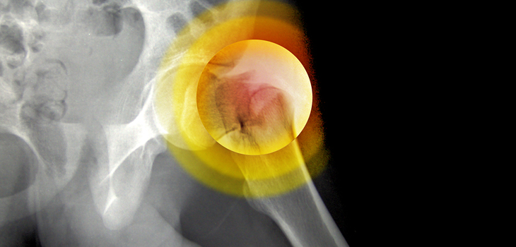 Hip Fracture Comorbidity Tips; Oxford UKA vs TKA Re-Op Rate; Anand Spine Group to Tackle TOPS