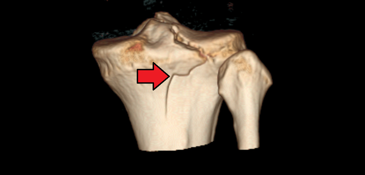 Tibial Plateau Fracture: Race, Ethnicity Don’t Affect Outcomes