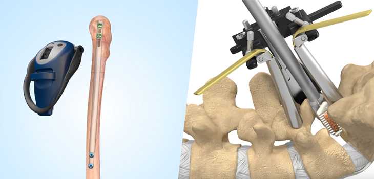 Expanded Clearances for Limb Lengthening and Interbody Systems