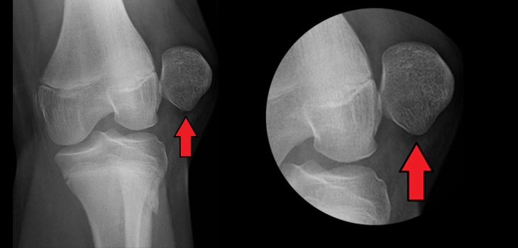 Patellar Dislocation: Does Surgery Give Best Results?