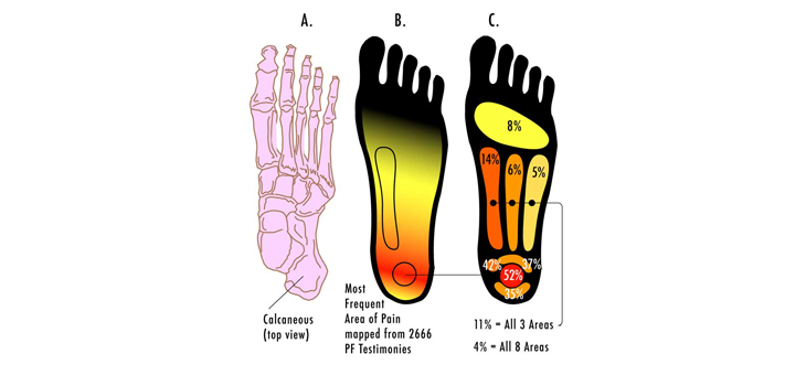 Drugstore Orthotics Work for Planter Fasciitis Treatment
