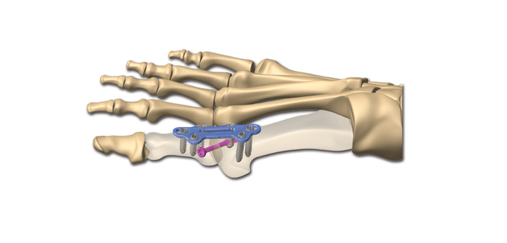 Extremity Medical Foot Fusion System Cleared