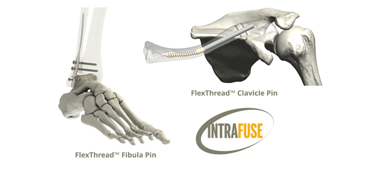 FDA Clears Way for Intramedullary Fixation for Extremities