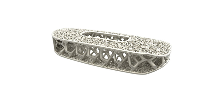 NuVasive Launches 3D-Printed Porous Titanium Implant