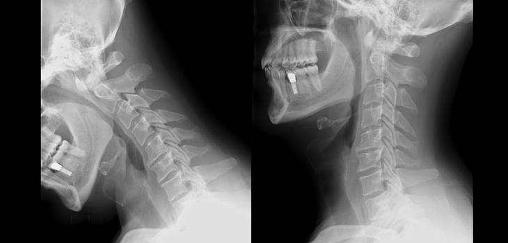 Two Surprising Keys to Cervical Realignment; New Bone Fracture Target: Air Pollution; J&J’s New “Engineering Studio” in Texas