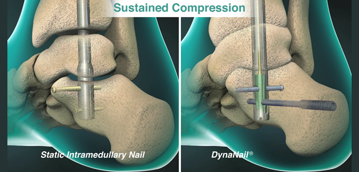 FDA Clears Longer DynaNail