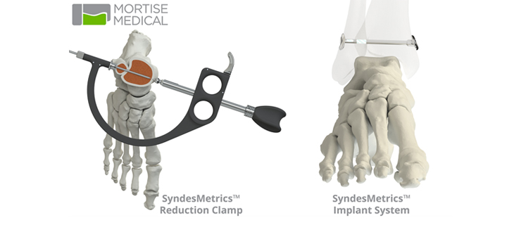 FDA Clears Mortise Medical Ankle Repair System