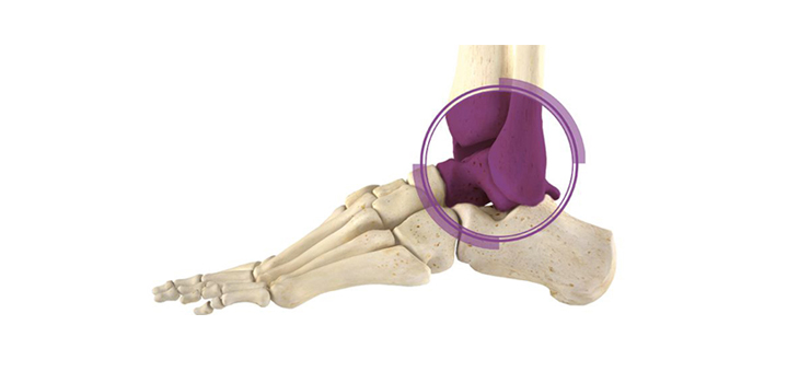 Ankle Replacements Improving But Still Lags