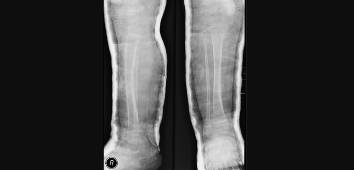 Obesity Threatens Leg Survival After Injury