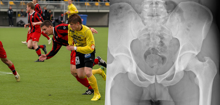 FAI: Arthroscopic Treatment Offers Athletes Faster Recovery