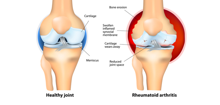 New Study: Vitamin D for Arthritis Did Not Work