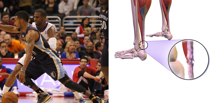 New Study: Achilles Tendon Inflammation in Injury Recovery