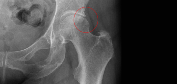 Does Arthroscopy Work for Hip Impingement?
