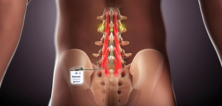 Mainstay Medical: Positive Results for ReActiv8‑B