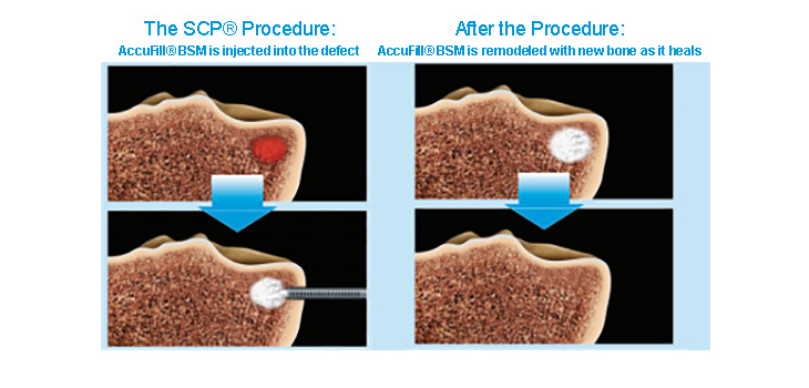 Subchondroplasty Viable Option for Hip Joint Replacement