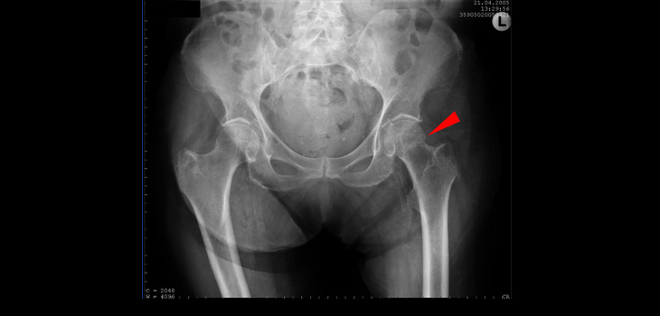 Study Says Repair Hip Fracture Within 24 Hours