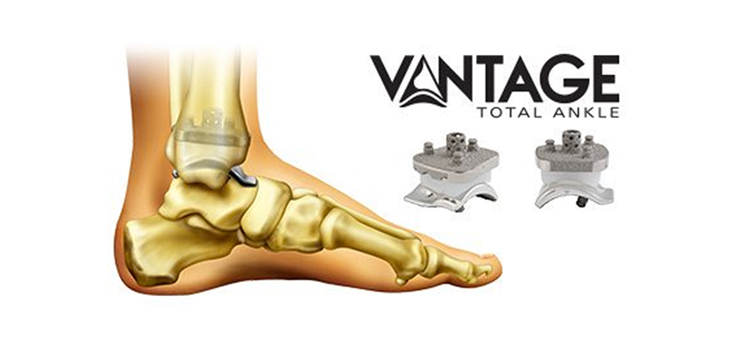Exactech Installs World’s First Mobile Bearing System Ankle