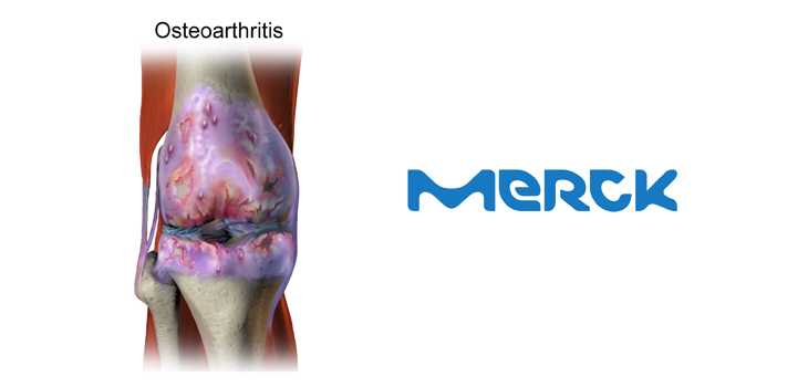 New Merck Drug Repairs Cartilage in OA Patients