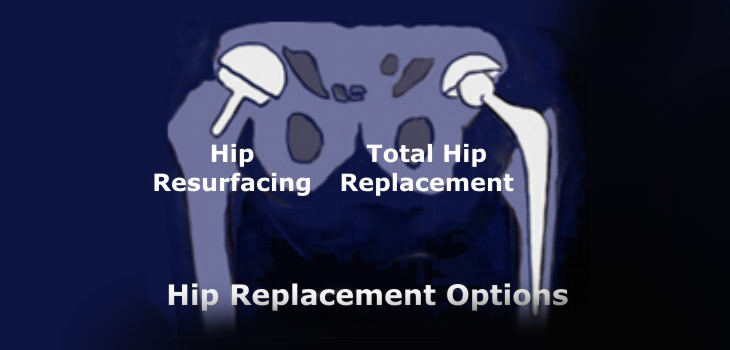Study: No Clinical Difference Between BHR and THA, But…; Outpatient Arthroplasty Safe as Inpatient; Operating on the Muscular Sclerotic Patient