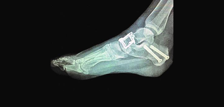 First Foot/Ankle Hybrid Fixation System Improves Bone Healing