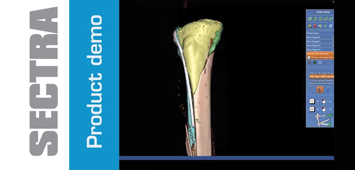 HSS Invests in Sectra Orthopaedic 3D Planning Software