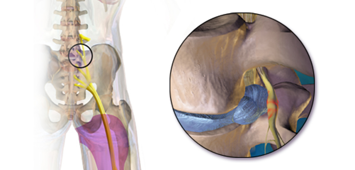 Non-Opioid Sciatica Treatment Fast Tracked by FDA