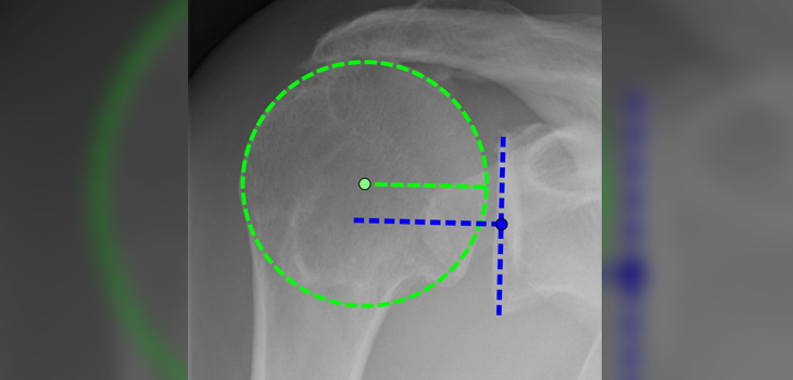 New Steadman Study: 5-Yr Arthroscopic Supraspinatus Repair Outcomes