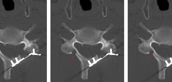 Laminoplasty Is IT for Some Multilevel Myelopathy