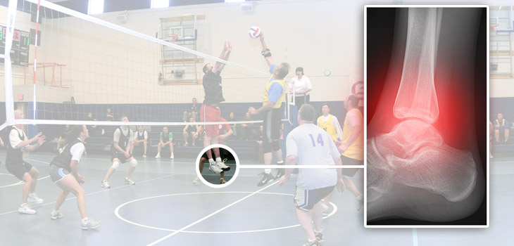 Volleyball: Blocking the Cause of Most Ankle Injuries