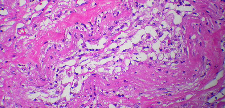 Using “Stem Cells” in a Sports Med Practice: Case Study