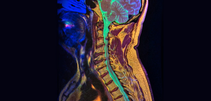 New Spine Study: When Images Don’t Match Symptoms; New Tobramycin Study; Machine Learning Transforms Meniscal Imaging