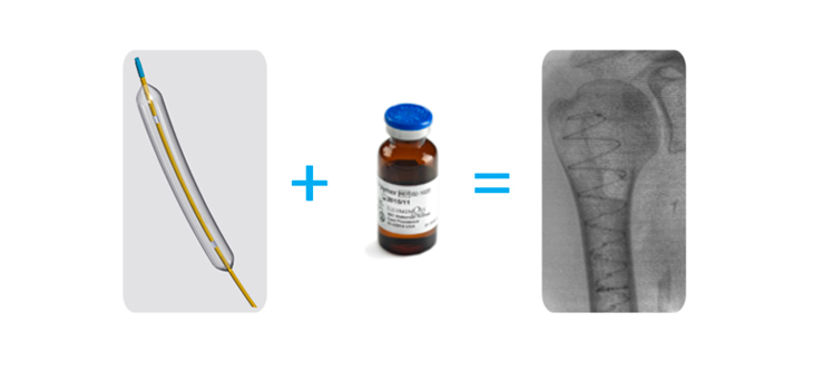 IlluminOss Medical Gets First FDA Ortho De Novo Clearance