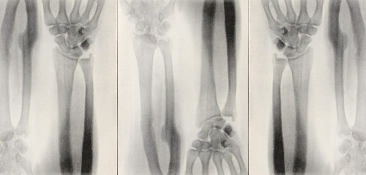Trabecular Metal Implants for Ulnar Nonunions?