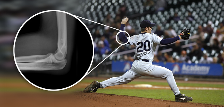 Does Tommy John Surgery Affect Pitcher Longevity?