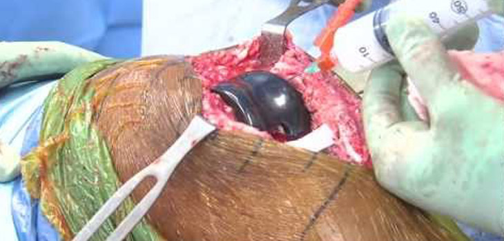 Eliminate Nerve Blocks and Opioids in Knee Arthroplasty?