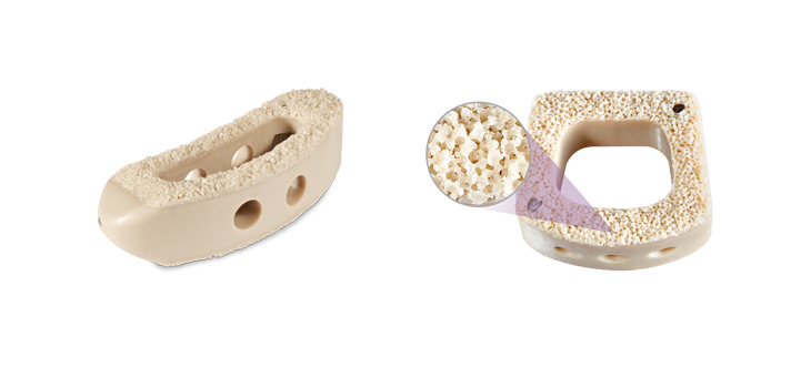 NuVasive Extends Porous PEEK Interbody to TLIF, PLIF