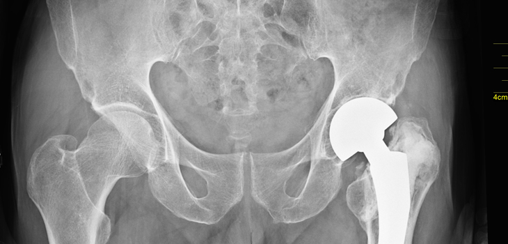 Hip Surgery? Try Digital Imaging Intraoperatively
