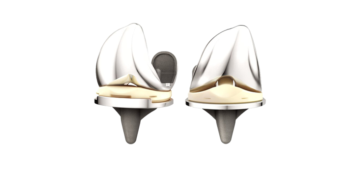 Lawsuit Over Alleged “Debonding” Hits DePuy’s ATTUNE Knee