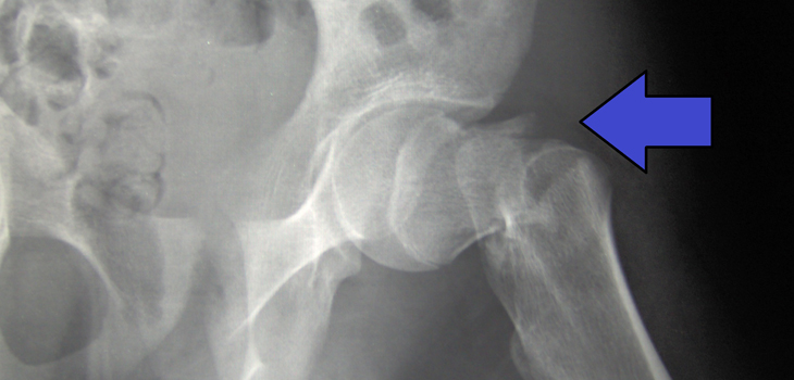 Hip Fracture Surgery: A Notably Effective Training Tool