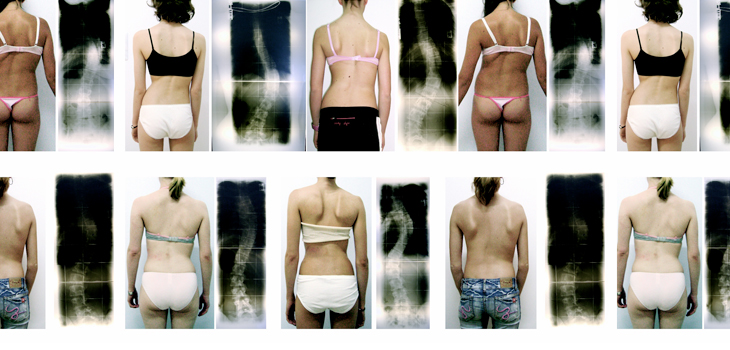 Posterior or Anterior for Scoliosis? Surprising New Answer; How Does RA Affect Sagittal Alignment?; Study: First Systematic Review of Anterior vs. Posterior in THA