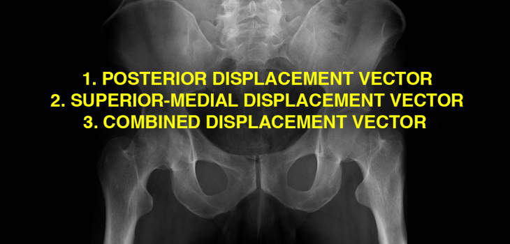 Rethinking Acetabular Fractures: A New Classification System