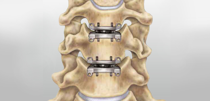 Multiple Level Cervical Disc Replacement Cost Study