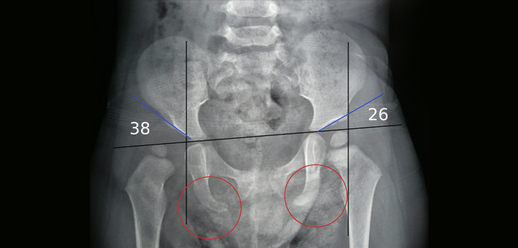 Hip Dysplasia: High Incidence, Surprising Findings