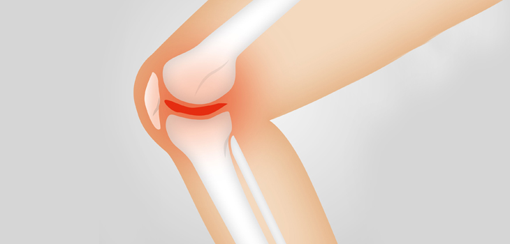 Is RCGD 423 an Arthritis Disease Modifier?