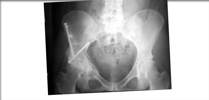 Periacetabular Osteotomy for Acetabular Dysplasia