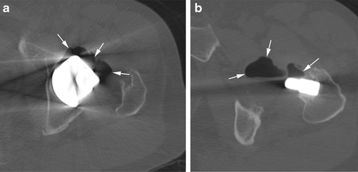 New Study: Early Irrigation Debridement vs. Joint Infection