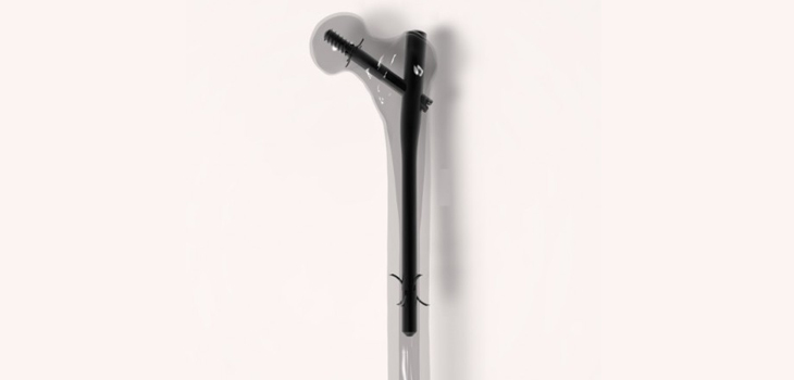 Humeral Nail System Cleared in Under 30 Days